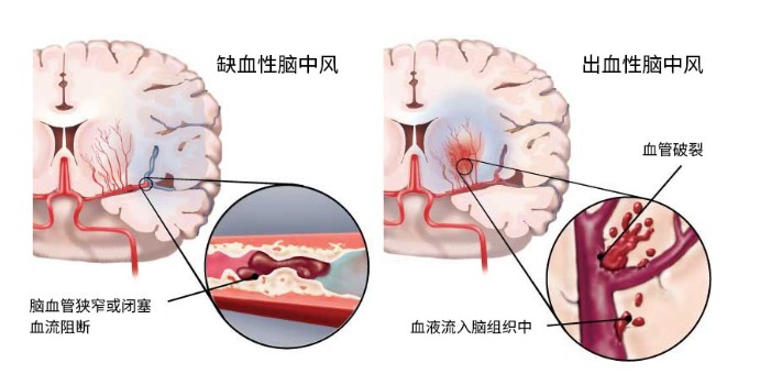 得了腦中風(fēng)保險(xiǎn)公司怎么賠